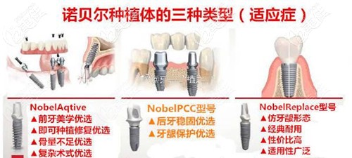 諾貝爾種植體的幾種型號