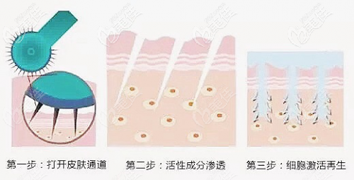 微針去頸紋的治療過程 微針去頸紋的治療過程