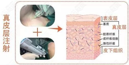 嗨體注射去頸紋過程 嗨體注射去頸紋過程
