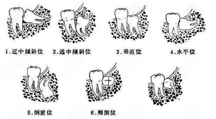 智齒生長的位置