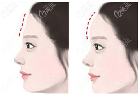 假體豐額頭效果圖參考 假體豐額頭效果圖參考