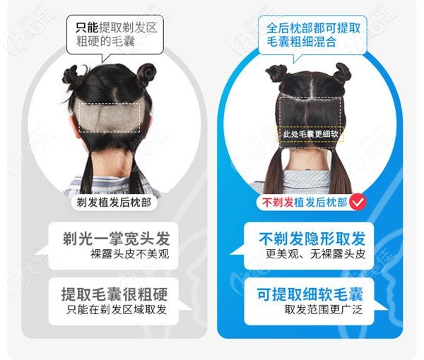 成都首瑞不剃發(fā)植發(fā)技術(shù) 成都首瑞不剃發(fā)植發(fā)技術(shù)