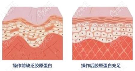 熱瑪吉抗衰皮膚前后效果對比變化示意圖