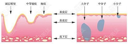 艾莉薇風(fēng)尚玻尿酸一支的價格