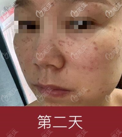 皮秒祛斑后第二天 皮秒祛斑后第二天