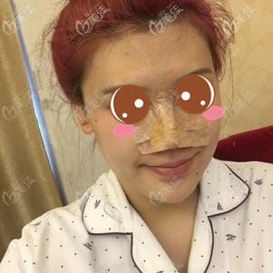 在福州格萊美做鼻修復(fù)術(shù)后2天