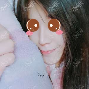 在福州格萊美做鼻修復(fù)術(shù)后7天