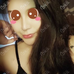 在福州格萊美做鼻修復(fù)術(shù)后1個(gè)月