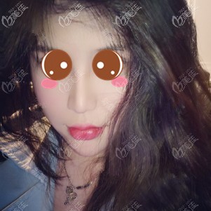 在福州格萊美做鼻修復(fù)術(shù)后2個(gè)月