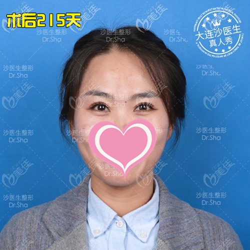 大連沙醫(yī)生雙眼皮案例 大連沙醫(yī)生雙眼皮案例