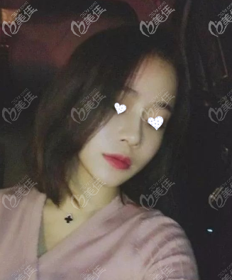 趁活動(dòng)價(jià)用4萬塊做了膨體半肋鼻綜合，挺正的，沒歪