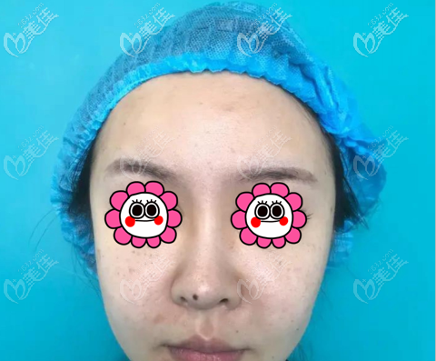 做微創(chuàng)假體墊眉弓前 做微創(chuàng)假體墊眉弓前