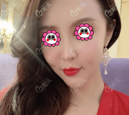 我做完微創(chuàng)假體墊眉弓,眼睛腫得不是很厲害,也沒(méi)發(fā)現(xiàn)有啥危害