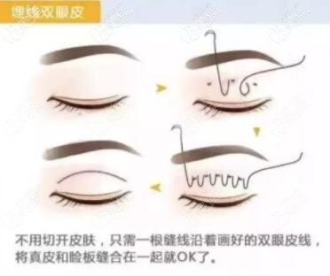 納米無痕埋線雙眼皮手術(shù)過程示意圖