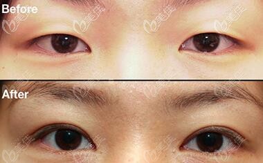 做納米無痕雙眼皮前后效果對比照