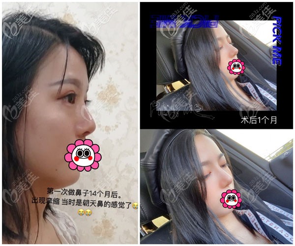 張龍鼻修復案例