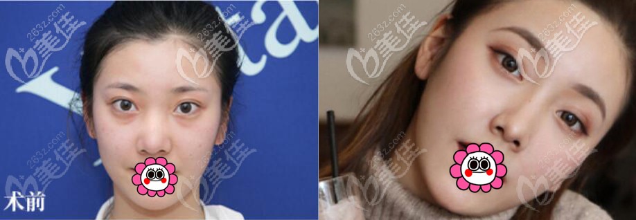 徐利剛隆鼻案例