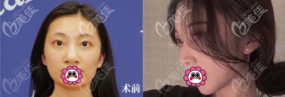 付德剛隆鼻案例