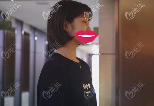 在長春中妍奧克拉做雙眼皮術(shù)前 在長春中妍奧克拉做雙眼皮術(shù)前