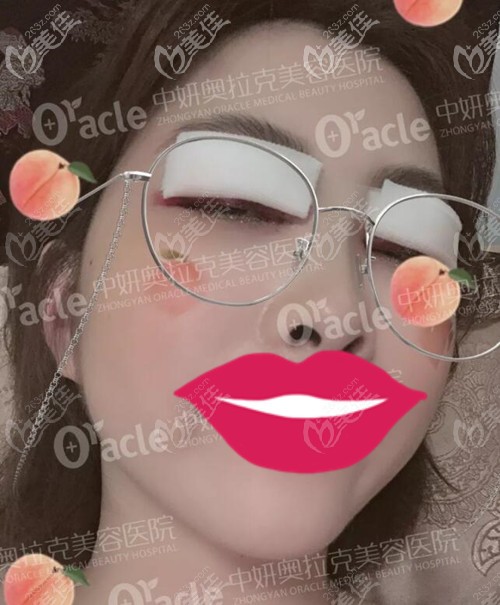 在長春中妍奧克拉做雙眼皮術(shù)后1天 在長春中妍奧克拉做雙眼皮術(shù)后1天