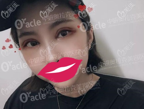 在長春中妍奧克拉做雙眼皮術(shù)后2天 在長春中妍奧克拉做雙眼皮術(shù)后2天