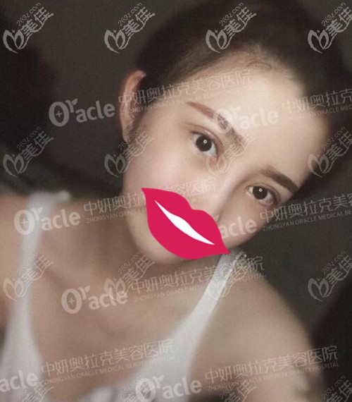 在長春中妍奧克拉做雙眼皮術(shù)后4天 在長春中妍奧克拉做雙眼皮術(shù)后4天