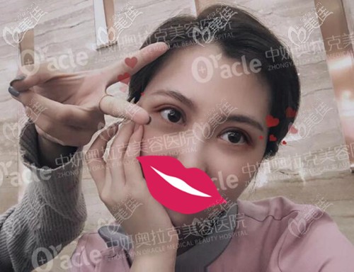 在長春中妍奧克拉做雙眼皮術(shù)后7天 在長春中妍奧克拉做雙眼皮術(shù)后7天