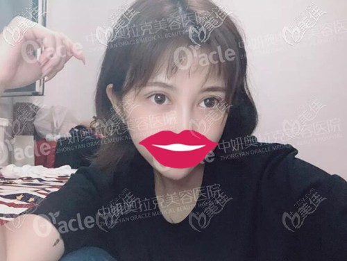 在長春中妍奧克拉做雙眼皮術(shù)后12天 在長春中妍奧克拉做雙眼皮術(shù)后12天