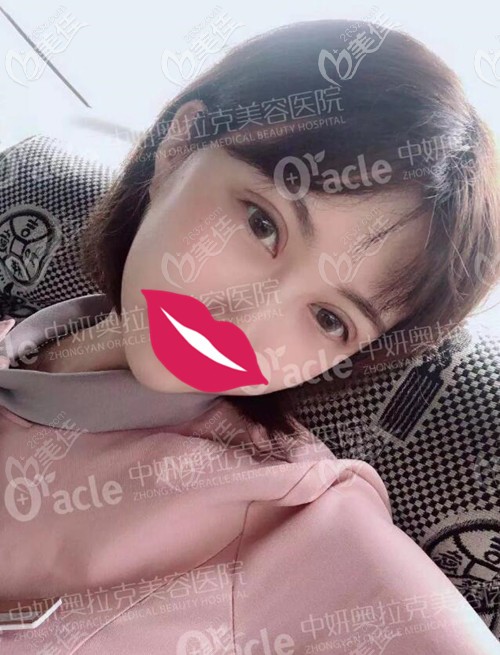 長(zhǎng)春全切雙眼皮手術(shù)17天恢復(fù)過程分享：超全面診流程都在這里