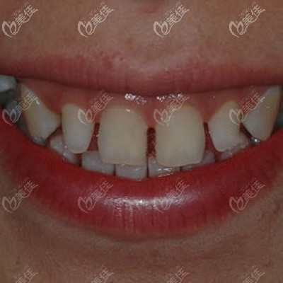 牙齒黃空隙還大的術(shù)前照片 牙齒黃空隙還大的術(shù)前照片