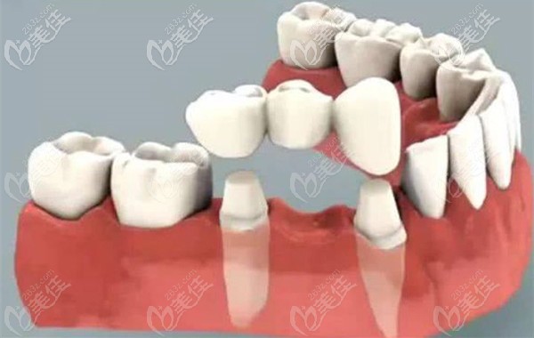 瓷貼面手術(shù)的原理 瓷貼面手術(shù)的原理