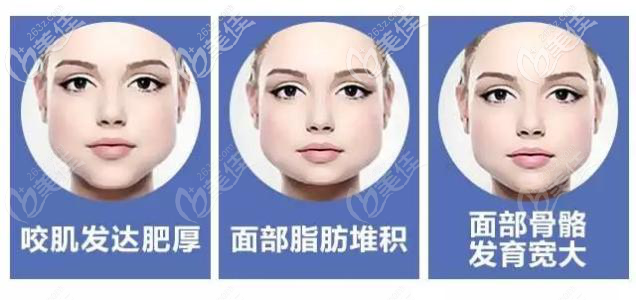 咬肌和脂肪堆積的下頜角肥大 咬肌和脂肪堆積的下頜角肥大