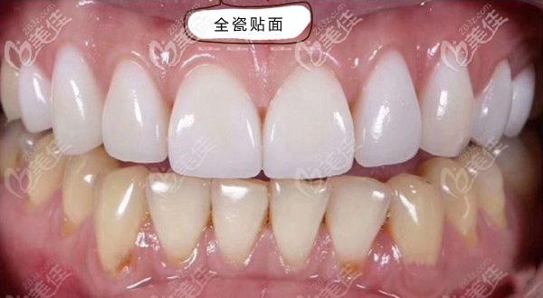 全瓷貼面修復(fù)效果圖