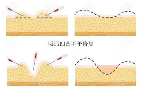 大腿吸脂失敗修復(fù)辦法 大腿吸脂失敗修復(fù)辦法