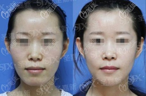 北京圣嘉新張笑天顴骨整形對比圖