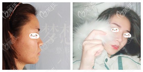 <!--<i data=20240703-sp></i>-->的肋骨鼻子案例 <!--<i data=20240703-sp></i>-->的肋骨鼻子案例