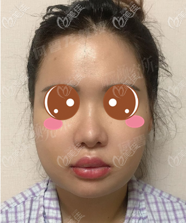 <!--<i data=20240703-sp></i>-->時光何晉龍正頜整形術(shù)后第七天