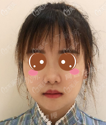 <!--<i data=20240703-sp></i>-->時光何晉龍正頜整形術(shù)后十五天