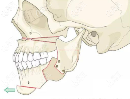 <!--<i data=20240703-sp></i>-->時光何晉龍正頜整形