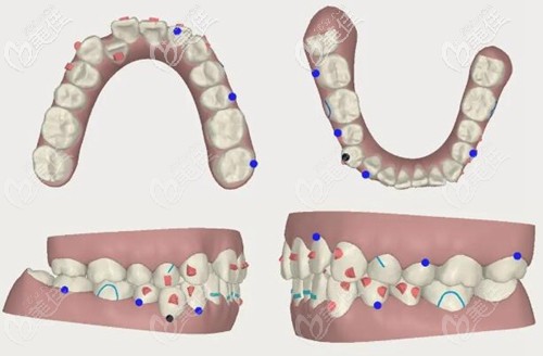 牙套作用力不對會造成牙齒脫落 牙套作用力不對會造成牙齒脫落