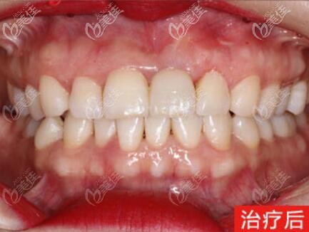 我前門牙缺失，在三亞口腔醫(yī)院做了韓國登騰種植牙效果挺好的，價格也不貴！