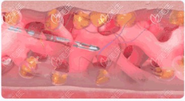 張悅迪醫(yī)生做面部抽脂不損傷血管網(wǎng)