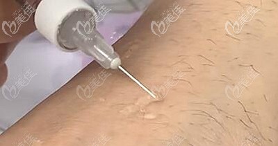 鉑金瑞藍(lán)玻尿酸的柔軟程度