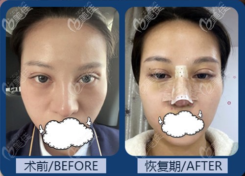 四川東籬整形醫(yī)院做鼻綜合手術(shù)(自體肋軟骨加韓氏生科一段)案例效果