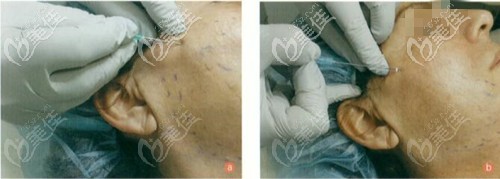 鋸齒線一般埋到筋膜層