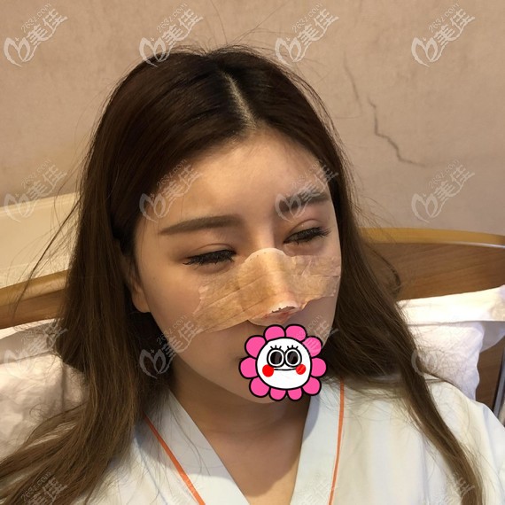 鼻修復(fù)術(shù)后即刻