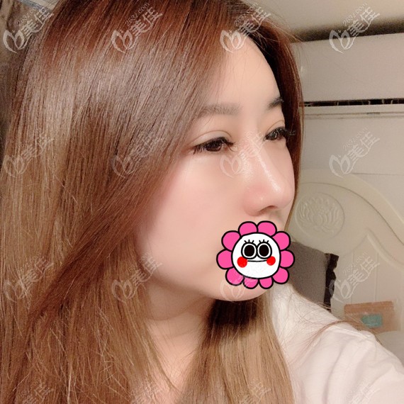 鼻修復(fù)拆線后<span style=