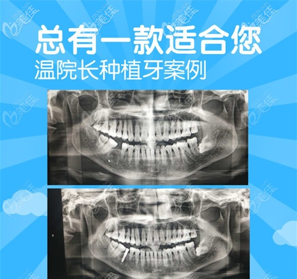 秦皇島藍(lán)天種植牙價格表
