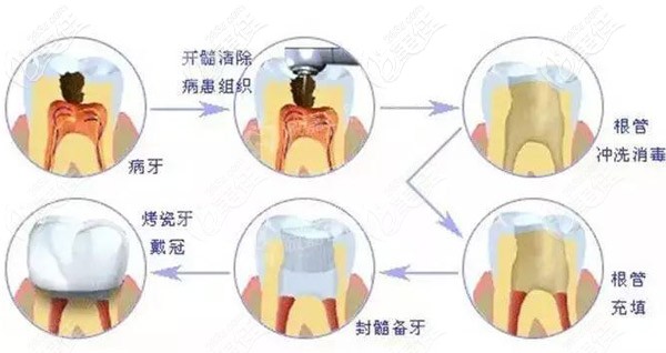 根管治療后堅(jiān)決不做牙冠會(huì)導(dǎo)致什么？