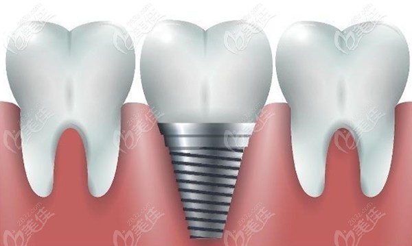 齊佳妮醫(yī)生已完成200多顆牙齒種植 齊佳妮醫(yī)生已完成200多顆牙齒種植
